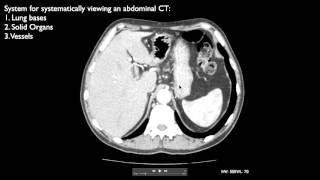 How to interpret an abdominal CT [upl. by Akessej]