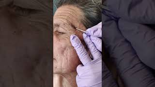 Acne extraction of blackheads and whiteheads popping pimples in Los Angeles [upl. by Lanevuj]