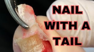 Ingrown Toenail With A Tail Ingrown Nail Removal [upl. by Jilly]