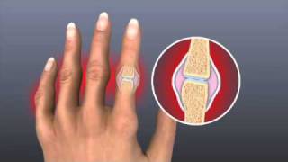 Rheumatic Fever Informative Video [upl. by Zitvaa]