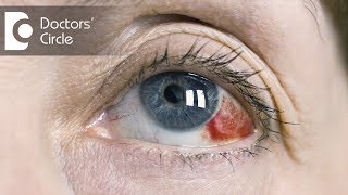 Causes of red clots in eyes  Dr Mala Suresh [upl. by Enialedam]