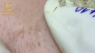 Blackheads and Whiteheads extraction 410  Loan Nguyen [upl. by Donnelly34]