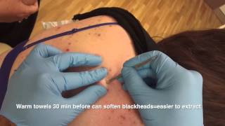 Blackheads back removal  the Australian Anaconda [upl. by Cinnamon]