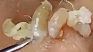 Deep blackhead extraction Cystic acne amp pimple popping 10 [upl. by Darnoc]