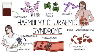 Haemolytic Uraemic Syndrome [upl. by Eudo]