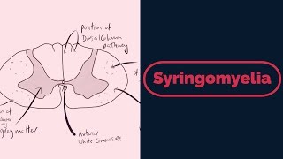 Syringomyelia Rapid Review [upl. by Otrevire]