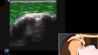 How To Shoulder Biceps Tendon 3D Video [upl. by Clementas]