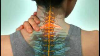 Cervical Radiculopathy  DePuy Videos [upl. by Nerhe]