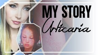 My Story Urticaria Chronic Idiopathic Hives [upl. by Reel]