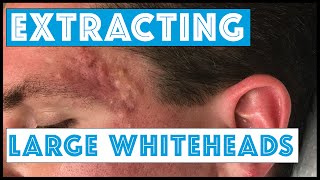 Acne Vulgaris and Extracting large Whiteheads  Part 1 [upl. by Rajewski]