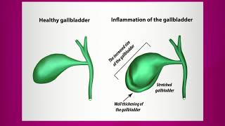 Pain Caused by Gallbladder Inflammation [upl. by Risley598]