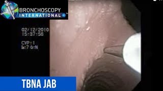 Flexible Bronchoscopy Basic Techniques 2  TBNA External View [upl. by Bergh]