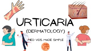 Urticaria  Dermatology Pathophysiologyclinical featuresdiagnosistreatment MedVidsMadeSimple [upl. by Adeirf729]