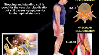 Lumbar Spinal Stenosis  Everything You Need To Know  Dr Nabil Ebraheim [upl. by Bollinger246]