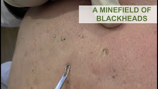 A Minefield of Blackheads  Dr Derm [upl. by Khalin401]