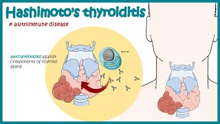 Hashimotos thyroiditis  Autoimmune diseases [upl. by Atteuqram]