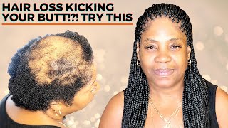 HOW TO BOX BRAID FOR BEGINNERS ALOPECIA VERSION [upl. by Bryna454]