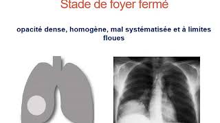 1 ABCÈS PULMONAIRE  Quatrième Année Médecine [upl. by Ulberto411]