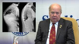 SRS Patient Video Kyphosis  George H Thompson MD [upl. by Haerr]