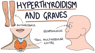 THYROID THURSDAY  Thyroid Antibodies and Thyroid Disease [upl. by Tennek]