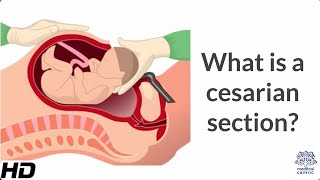 What is a Cesarian Section [upl. by Attenad569]