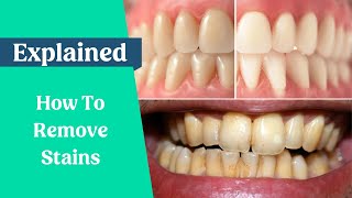 How to remove stains from the teeth [upl. by Vudimir]