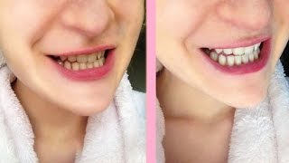 Crest white strips honest review [upl. by Schechinger]