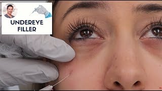 Undereye Filler By Leif Rogers MD FACS  Fanning Technique  Beverly Hills [upl. by Hilleary282]