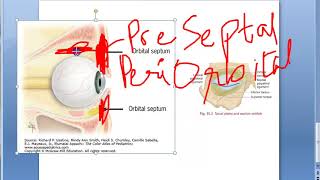 Ophthalmology 417 a Orbital Infection Orbital Cellulitis PreSeptal Post Septal Eye Swelling [upl. by Mccormac]