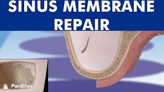 Sinus membrane perforation repair © [upl. by Kannan]