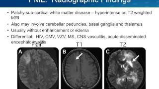 Progressive Multifocal Leukoencephalopathy PML [upl. by Bellis]