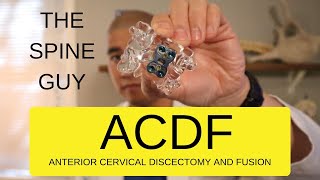 CERVICAL STENOSIS RADICULOPATHY  PART 5  ACDF [upl. by Benoite]