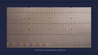 Electrical Alternans ECG [upl. by Sallyann565]