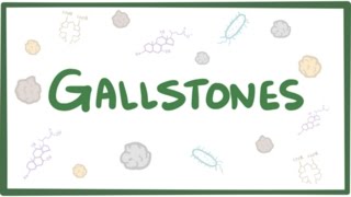 Gallstones cholelithiasis [upl. by Akeihsal]