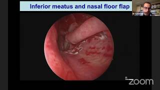 Septal Perforation Repair  How I Do It [upl. by Anthony]