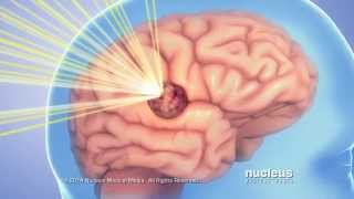 CAVERNOUS MALFORMATIONS OF THE BRAIN AND SPINAL CORD [upl. by Noraha]