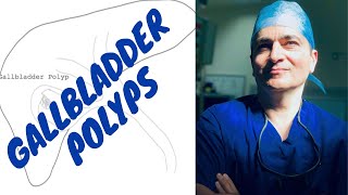 Gallbladder Polyps [upl. by Adnoluy968]