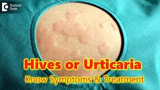 Hives  UrticariaCausesSymptomsTreatment  Skin Rash  Allergy  DrRasya Dixit  Doctors Circle [upl. by Perloff]