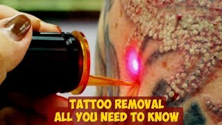 Tattoo Removal ► All You Need To Know [upl. by Ahsekyt]