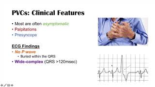 A Common Cause of Palpitations  Premature Ventricular Contractions PVCs Triggers amp Symptoms [upl. by Tingley]