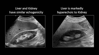 GI Imaging  Hepatic Steatosis and Cirrhosis [upl. by Anirol]