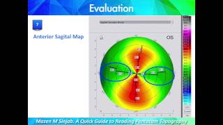 A Quick Guide to Reading Corneal Topography Part 1 [upl. by Yenots670]