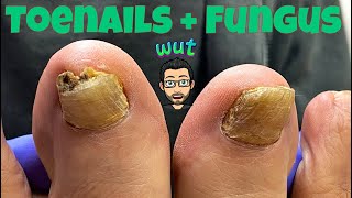 HOW TO CUT THICK TOENAILS WITH FUNGUS [upl. by Lesna]