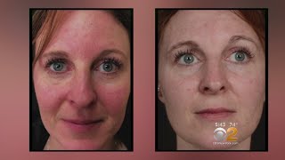 Health Watch New Laser Treatment For Rosacea [upl. by Saraiya730]