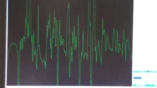 Myopathy EMG changes explained [upl. by Thedric]