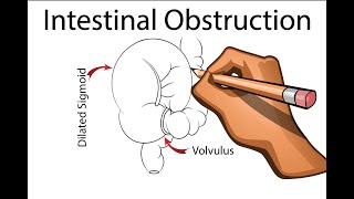 Intestinal Obstruction  Part 1 [upl. by Enahc]