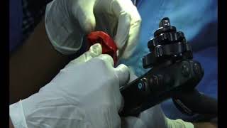 Endoscopic banding of esophageal varices [upl. by Campagna26]