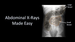 Abdominal XRays Made Easy [upl. by Dahle796]