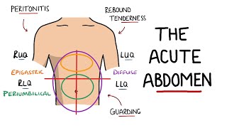 Acute Abdomen  A Guide to Acute Abdominal Pain [upl. by Crowns]