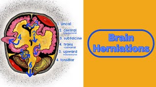 Brain Herniations and Raised ICP [upl. by Akenna]